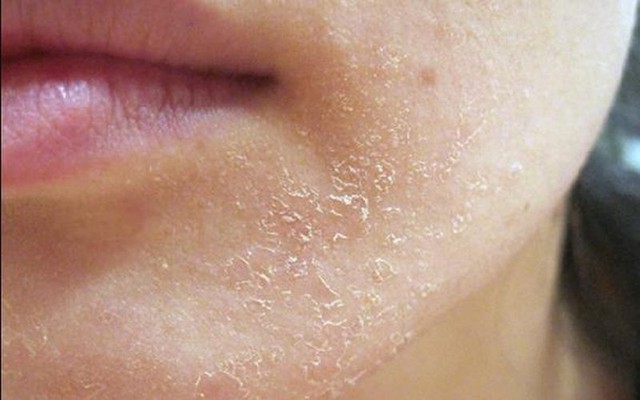 Những người da bị khô, nứt nẻ thường là khả năng tự tiết ra những chất hữu cơ tự nhiên cùng mồ hôi giúp da nhờn, đàn hồi và chống lại sự xâm nhập của các loại vi khuẩn của làn da bị giảm.Điều này càng tăng hơn khi thời tiết hanh khô.