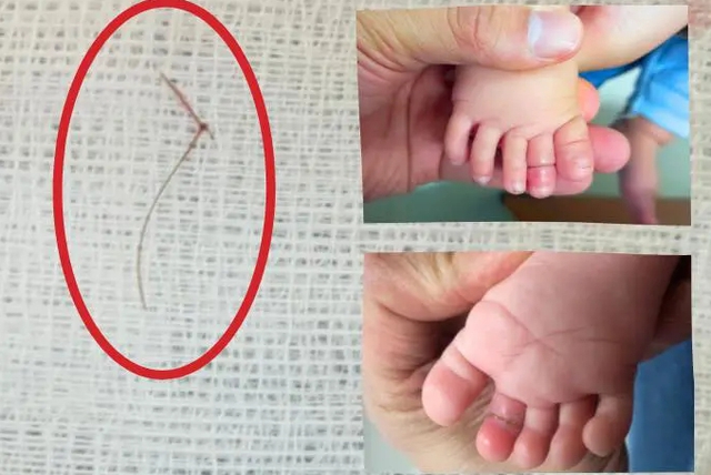 Dị vật thắt ngón chân là sợi tóc khiến bé giá 4 tháng tuổi suýt mất ngón chân.
