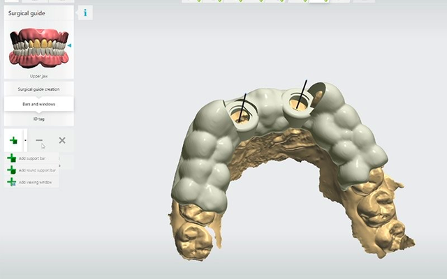 Máng định vị 3D Guide – Giảm nguy cơ biến chứng sau cấy ghép implant- Ảnh 2.