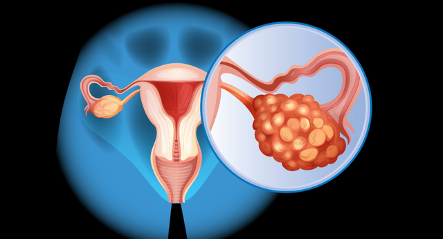 Các triệu chứng ung thư buồng trứng phụ nữ nên biết- Ảnh 1.