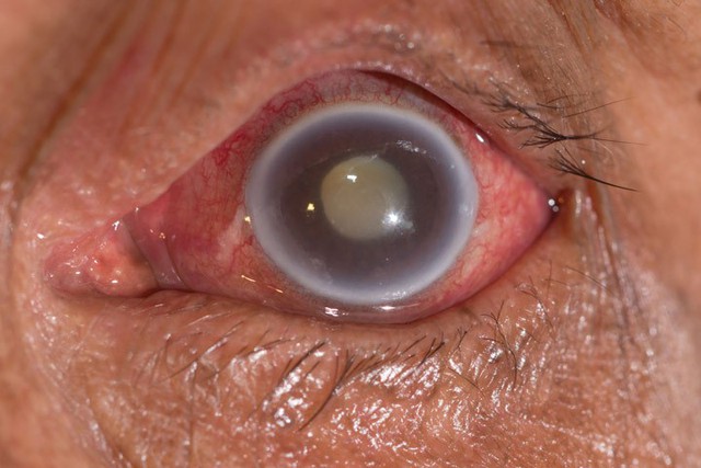 Nếu mắt có dấu hiệu này bạn có nguy cơ cao bị mất thị lực- Ảnh 1.