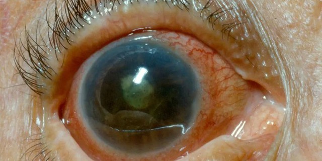 Nếu mắt có dấu hiệu này bạn có nguy cơ cao bị mất thị lực- Ảnh 2.