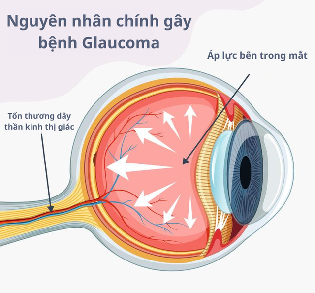 Hàng triệu người trên thế giới mù lòa vĩnh viễn vì căn bệnh Glôcôm- Ảnh 2.