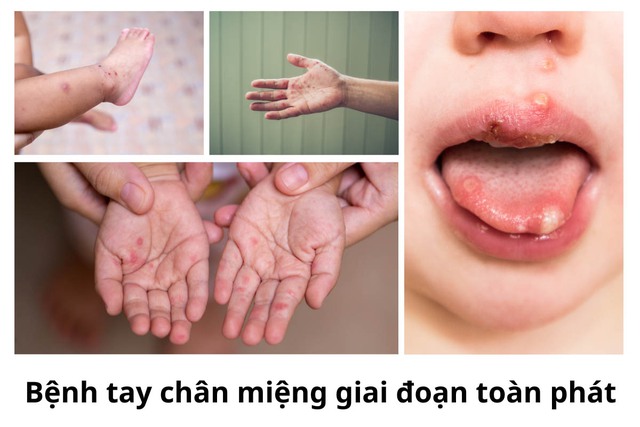 Số ca bệnh tay chân miệng tăng vọt, cần làm gì để phòng và điều trị cho trẻ?- Ảnh 2.