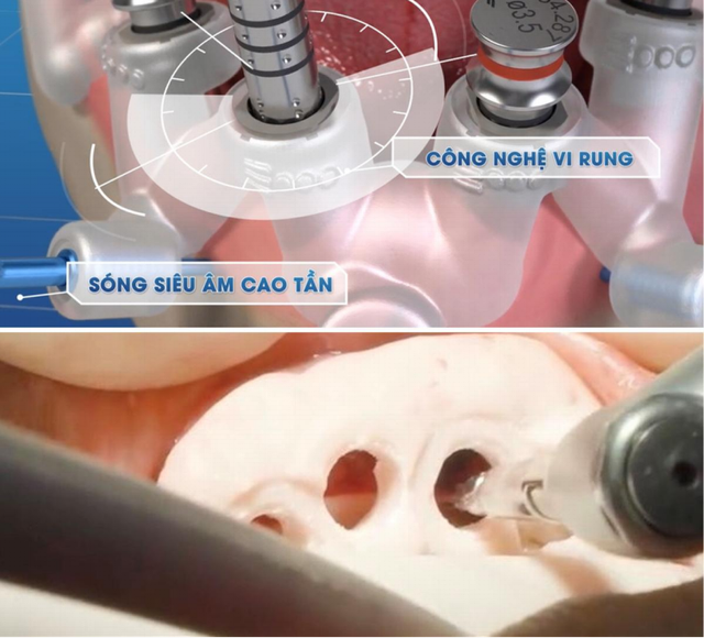 Trồng răng implant DCT - Giải pháp ăn nhai bền vững cho người mất răng- Ảnh 1.