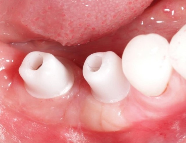 Trồng răng implant DCT - Giải pháp ăn nhai bền vững cho người mất răng- Ảnh 2.