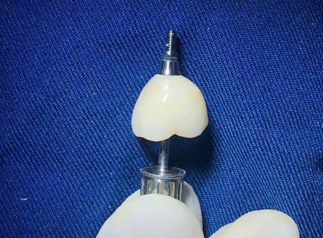 Trồng răng implant DCT - Giải pháp ăn nhai bền vững cho người mất răng- Ảnh 3.