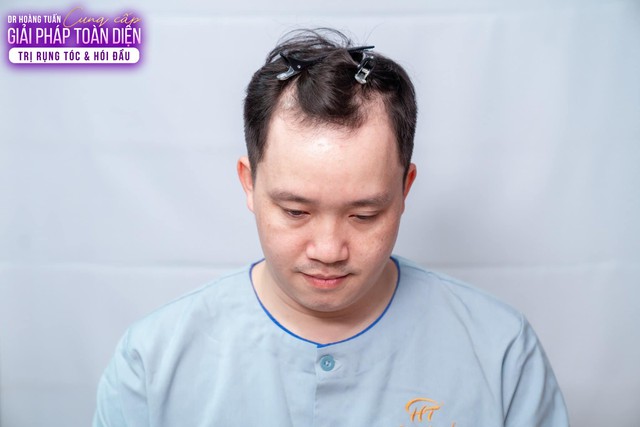 Thực trạng cấy tóc ở Việt Nam- Ảnh 1.