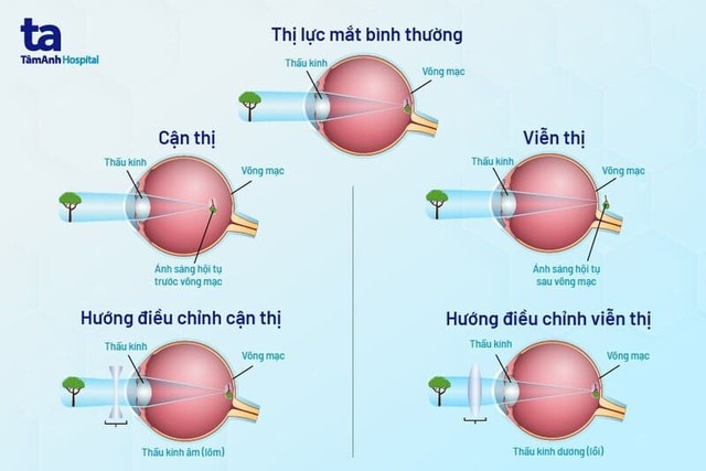 Số lượng thanh thiếu niên mắc các tật khúc xạ ở mắt ngày càng tăng, đâu là cách khắc phục hiệu quả?- Ảnh 1.