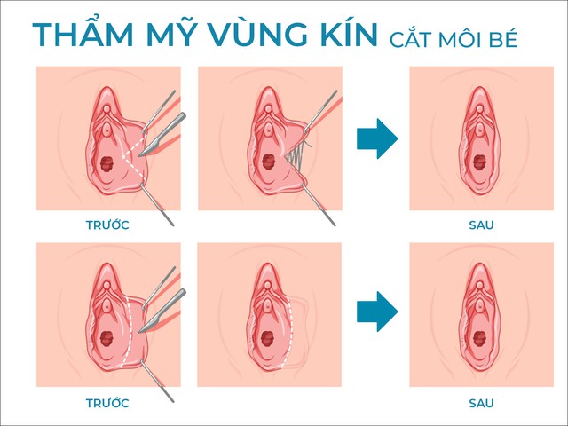 Trẻ hoá vùng kín bằng phẫu thuật: Thu hẹp âm đạo và tạo hình môi bé- Ảnh 2.