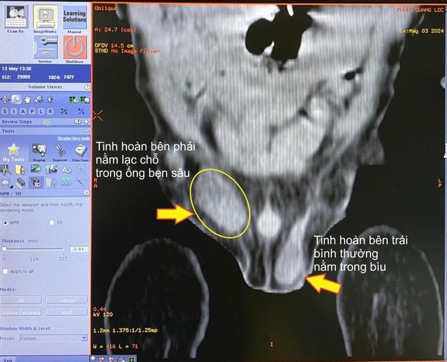 Bé trai không có tinh hoàn được các bác sĩ can thiệp kịp thời- Ảnh 1.