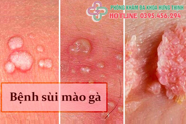 Địa chỉ phòng khám chữa bệnh sùi mào gà tốt ở Hà Nội- Ảnh 1.