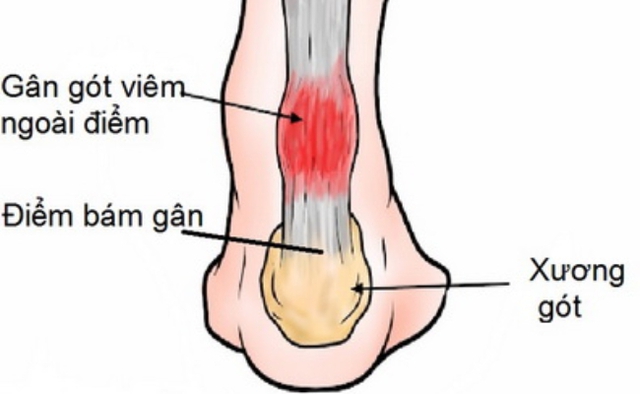 Gân Achilles là gân lớn nhất trong cơ thể con người.