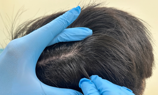 Nhiều người chọn giải pháo nhổ những sợi tóc đáng ghét đó mà không biết rằng việc làm này gây ảnh hưởng không nhỏ đến da đầu.