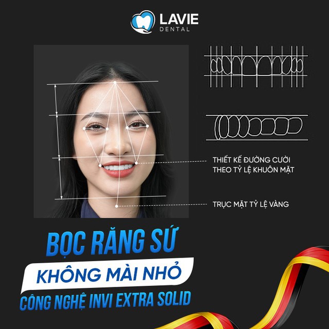 Invi Extra Solid - Công nghệ bọc răng sứ không mài nhỏ- Ảnh 2.