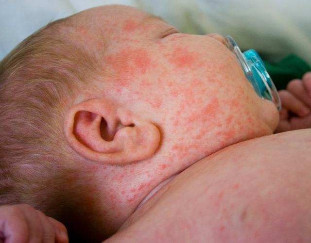 TPHCM ghi nhận 2 ca mắc bệnh sởi đầu tiên, đều chưa tiêm vaccine- Ảnh 1.