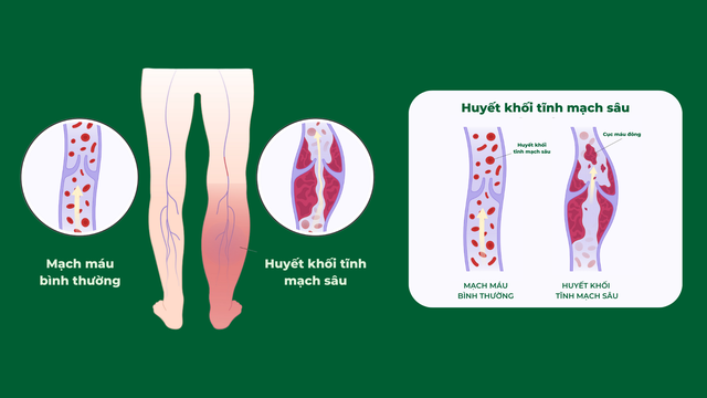 Biến chứng của tiêm xơ trong điều trị suy giãn tĩnh mạch- Ảnh 3.