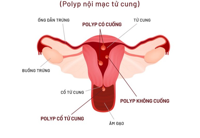 Polyp tử cung có ảnh hưởng đến khả năng sinh sản?- Ảnh 1.