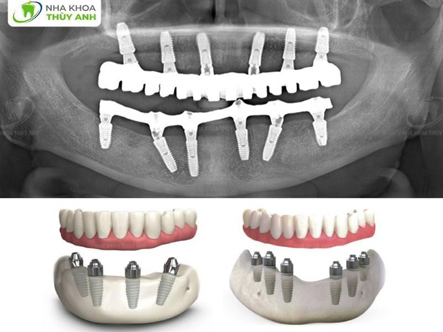 Trồng răng implant toàn hàm: An toàn - tiết kiệm chi phí- Ảnh 1.