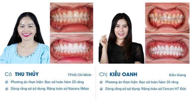 Bọc răng sứ giá bao nhiêu tại Nha Khoa I-Dent Diamondtech- Ảnh 3.