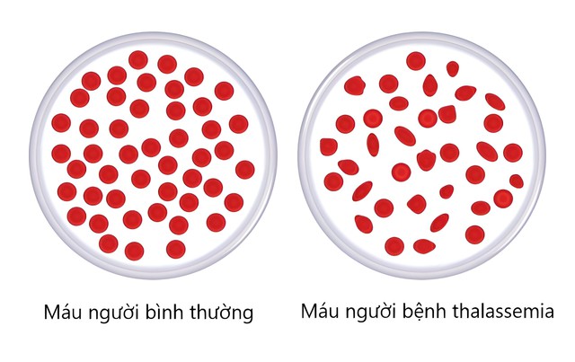 Thalassemia là bệnh tan máu bẩm sinh, di truyền theo kiểu gen lặn trên nhiễm sắc thể thường từ cha mẹ sang con qua các thế hệ.