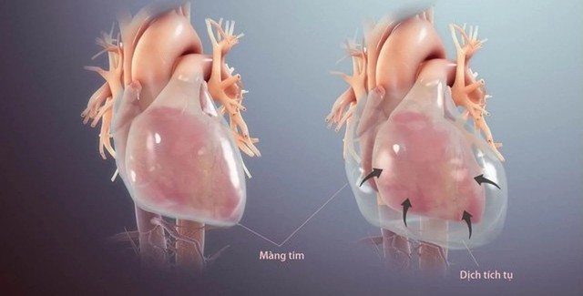 Viêm màng ngoài tim: Nguyên nhân, triệu chứng, cách điều trị và phòng ngừa- Ảnh 2.