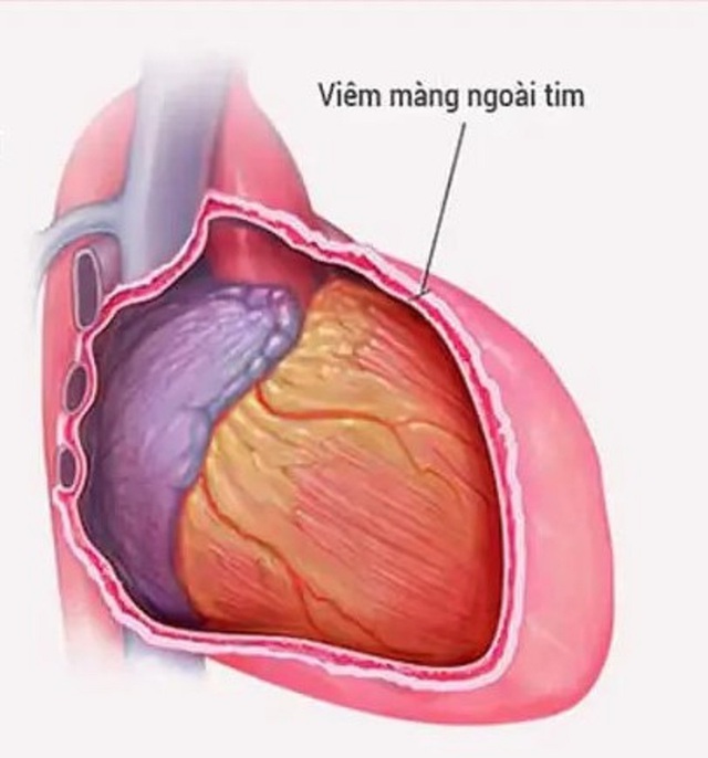 Viêm màng ngoài tim: Nguyên nhân, triệu chứng, cách điều trị và phòng ngừa- Ảnh 1.