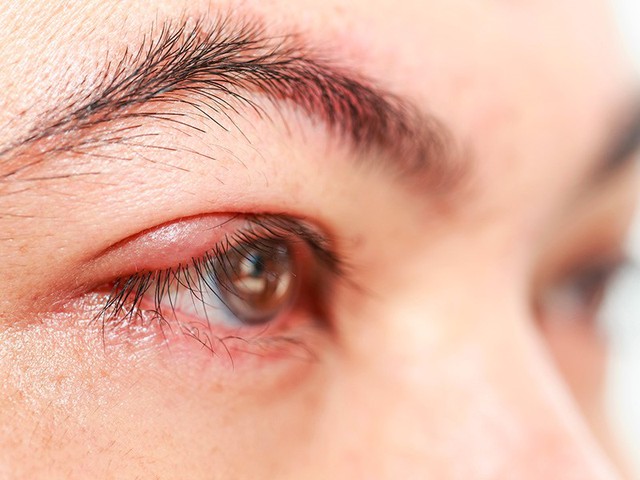 Những người bị viêm kết mạc dị ứng, dụi mắt như một phản ứng tự nhiên để hết ngứa, nhưng kỳ thực hành vi đó chẳng giải quyết được chứng ngứa mà còn gây đỏ mắt, tổn thương viêm nhiều hơn, thậm chí có thể gây giác mạc hình chóp.