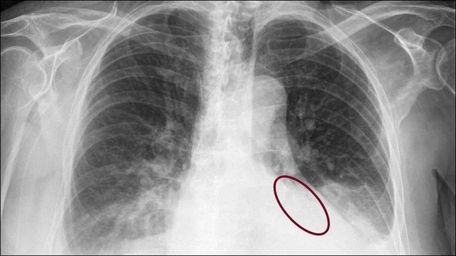 Bài tập cho người bệnh tràn dịch màng phổi- Ảnh 1.