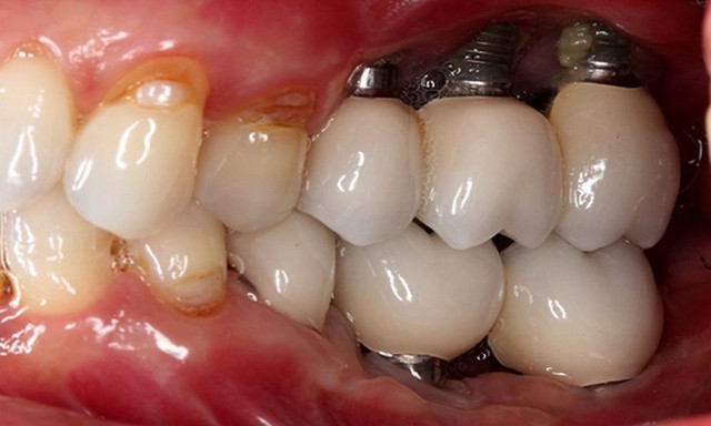 Máng hướng dẫn phẫu thuật Guideline - Bí quyết trồng răng implant an toàn, không biến chứng- Ảnh 1.