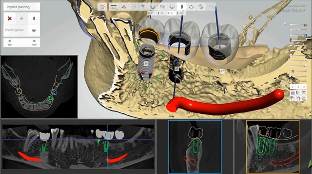 Máng hướng dẫn phẫu thuật Guideline - Bí quyết trồng răng implant an toàn, không biến chứng- Ảnh 2.