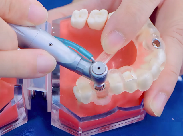 Máng hướng dẫn phẫu thuật Guideline - Bí quyết trồng răng implant an toàn, không biến chứng- Ảnh 3.