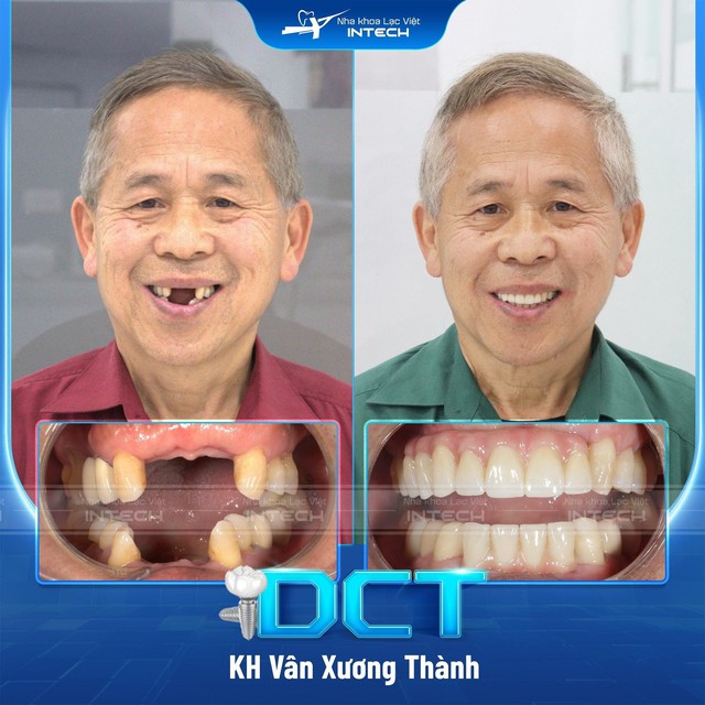 Giải pháp trồng răng implant cá nhân hóa DCT - Xu hướng trồng răng thế kỷ XXI- Ảnh 3.