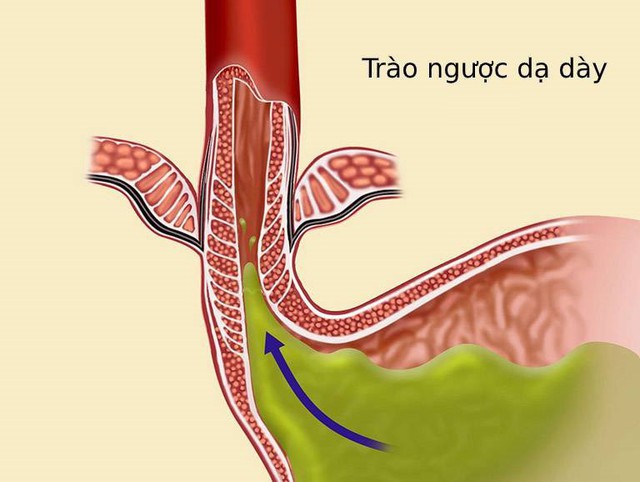 Trào ngược dạ dày thực quản (GERD) hay gọi là trào ngược dạ dày là một bệnh lý về đường tiêu hóa rất phổ biến tại Việt Nam.