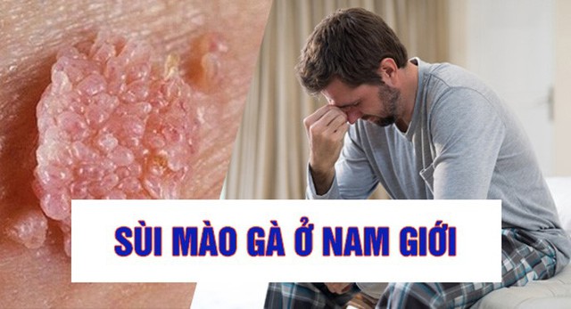 Sùi mào gà ở nam: Dấu hiệu, nguyên nhân, cách chữa- Ảnh 1.