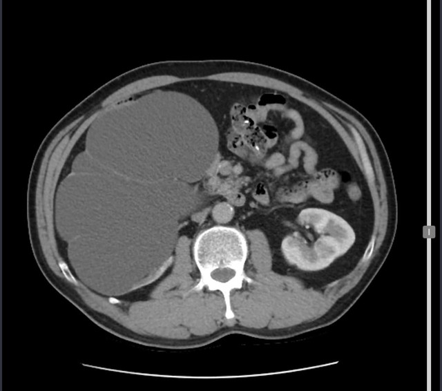 Thận to bằng quả bưởi do tự dùng thuốc nam điều trị sỏi niệu quản- Ảnh 2.