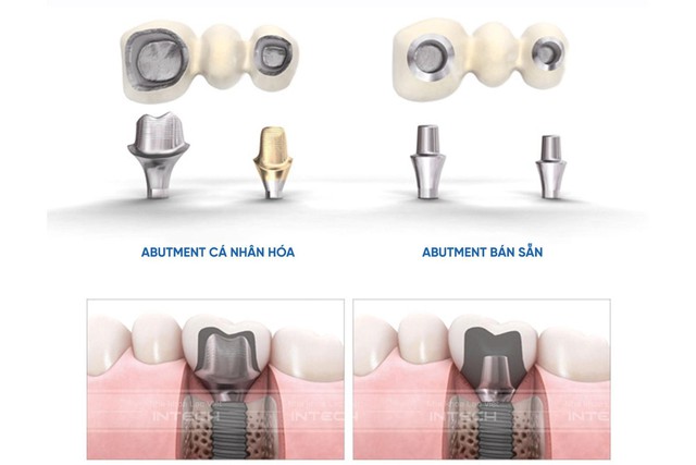 Chủ đề: Cùng tìm hiểu về trụ phục hình giải phẫu cá nhân hóa trong trồng răng implant công nghệ mới- Ảnh 2.