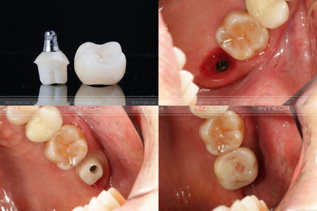 Chủ đề: Cùng tìm hiểu về trụ phục hình giải phẫu cá nhân hóa trong trồng răng implant công nghệ mới- Ảnh 3.