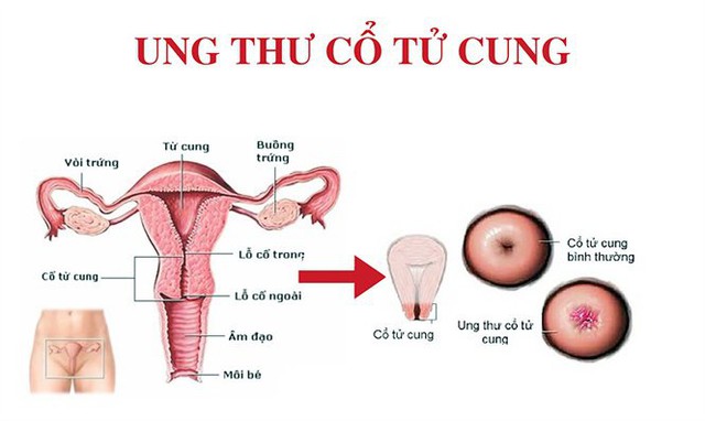 Khi một người nhiễm HPV không tự khỏi sẽ tiến triển thành ung thư cổ tử cung. Ảnh minh họa