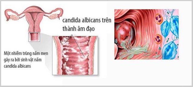 Cách đơn giản giúp chị em phòng bệnh nấm âm đạo- Ảnh 1.