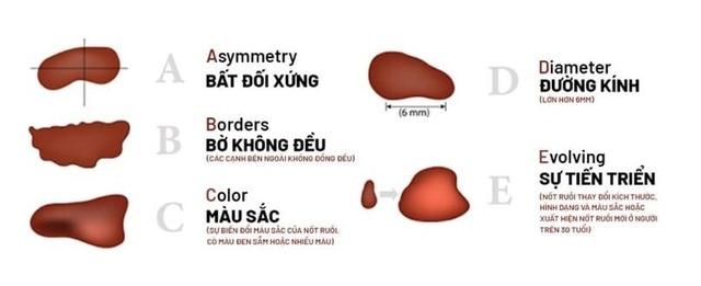 5 dấu hiệu ung thư da nhiều người nhầm lẫn- Ảnh 5.