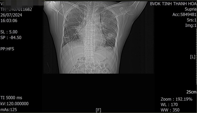 4 giờ ‘cân não’ bác sĩ cứu sống thanh niên vỡ tim, phổi do tai nạn giao thông- Ảnh 1.