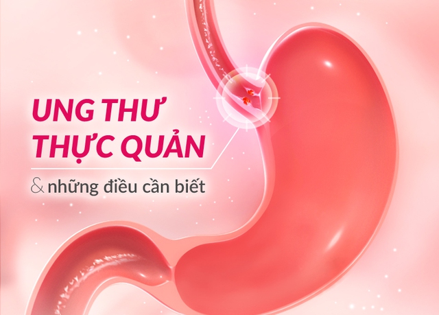 9 dấu hiệu cảnh báo ung thư thực quản- Ảnh 2.