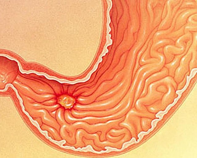 Thuốc và phương pháp điều trị viêm niêm mạc hang vị dạy dày- Ảnh 1.