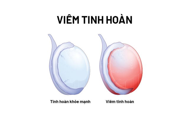 Chế độ ăn cho người bệnh viêm tinh hoàn- Ảnh 1.