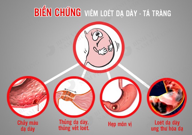 Câu hỏi thường gặp liên quan đến loét dạ dày tá tràng- Ảnh 2.