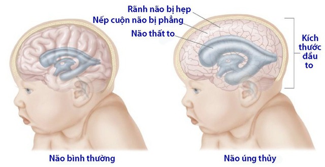 Một số câu hỏi thường gặp liên quan đến não úng thủy- Ảnh 1.