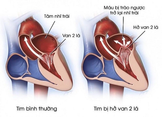 Dấu hiệu nhận biết hở van tim 2 lá và cách phòng ngừa- Ảnh 1.