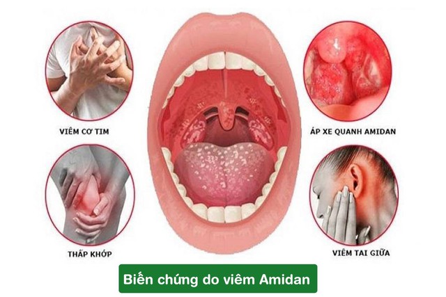 Nguyên nhân viêm amidan thường gặp và cách đối phó hiệu quả- Ảnh 2.