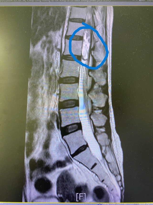 Bệnh nhân u tủy sống thoát khỏi nguy cơ liệt 2 chân nhờ bóc tách khối u- Ảnh 1.